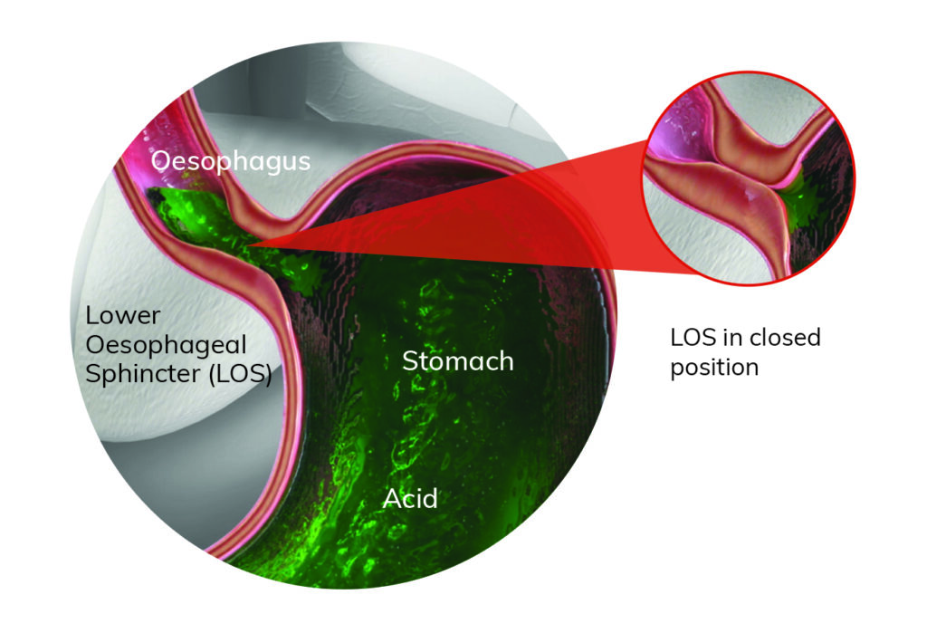 How is Acid Reflux Diagnosed - OPA Cancer Charity