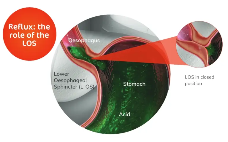 How is Acid Reflux Diagnosed - OPA Cancer Charity