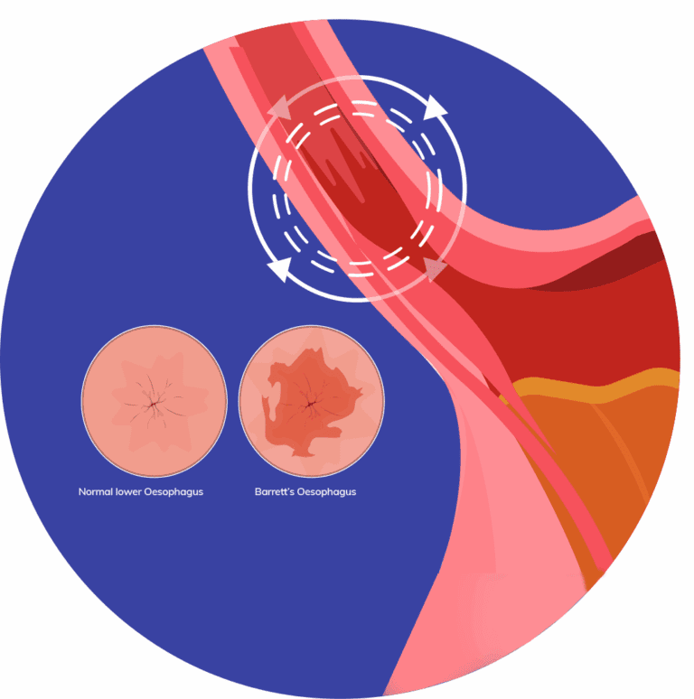 Barrett’s Oesophagus Diagram