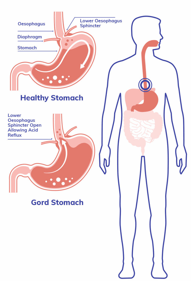 Comparison of a Healthy Stomach and a Stomach Suffering with GORD